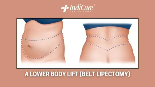 A lower body lift (belt lipectomy) A lower body lift (belt lipectomy)